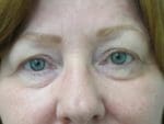 Eyelid Surgery - Case 116-5 - Before