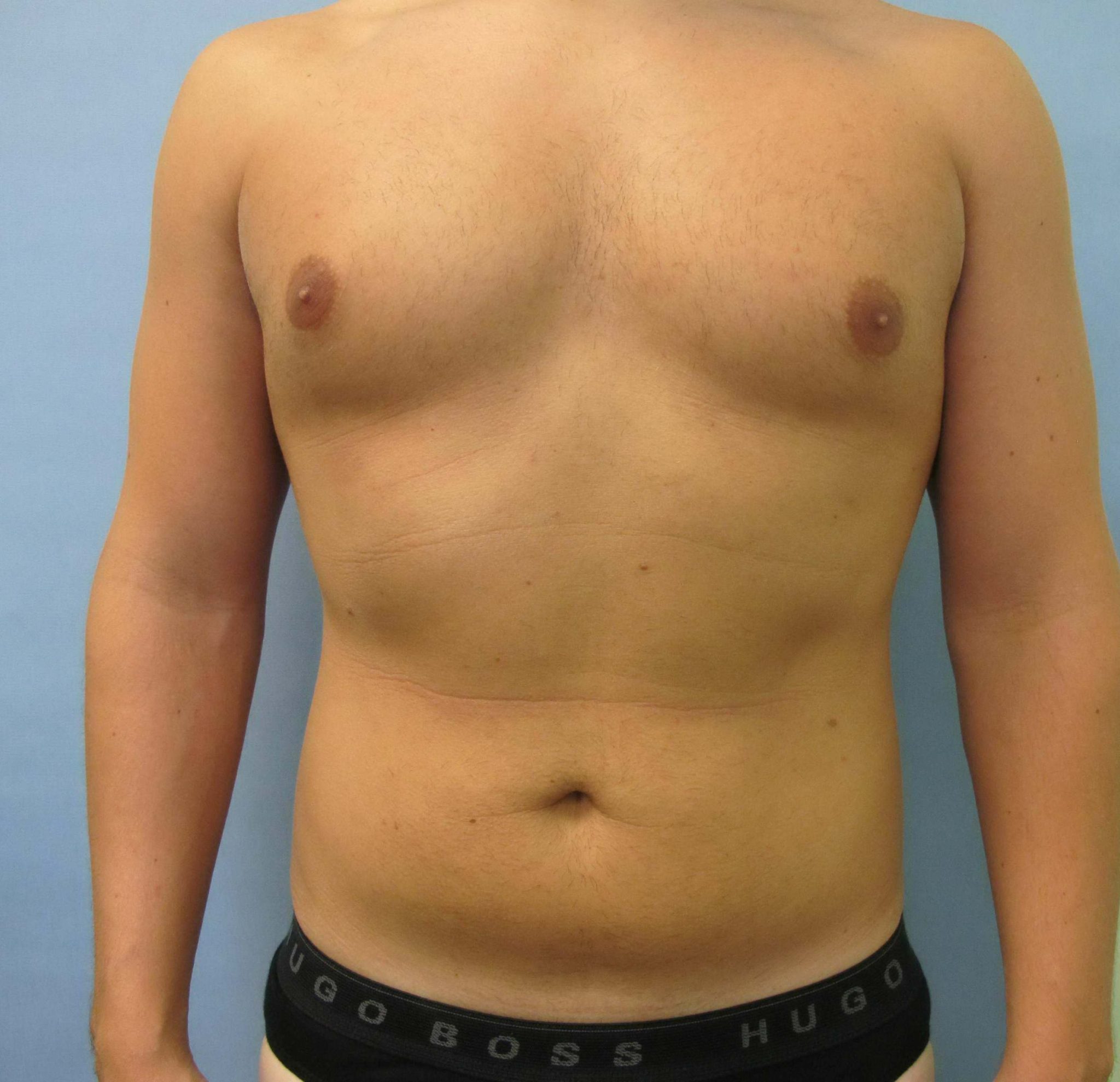 Liposuction Patient Photo - Case 118 - before view-