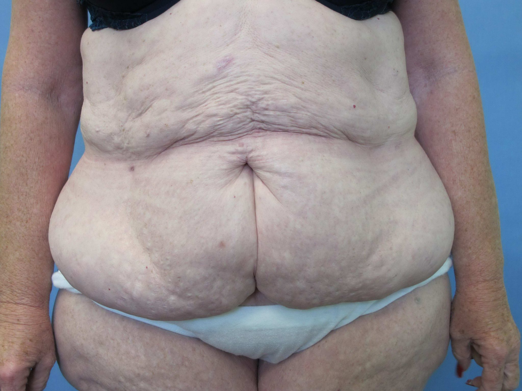 Tummy Tuck Patient Photo - Case 78 - before view-