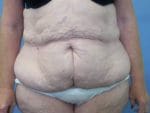 Liposuction - Case 78 - Before