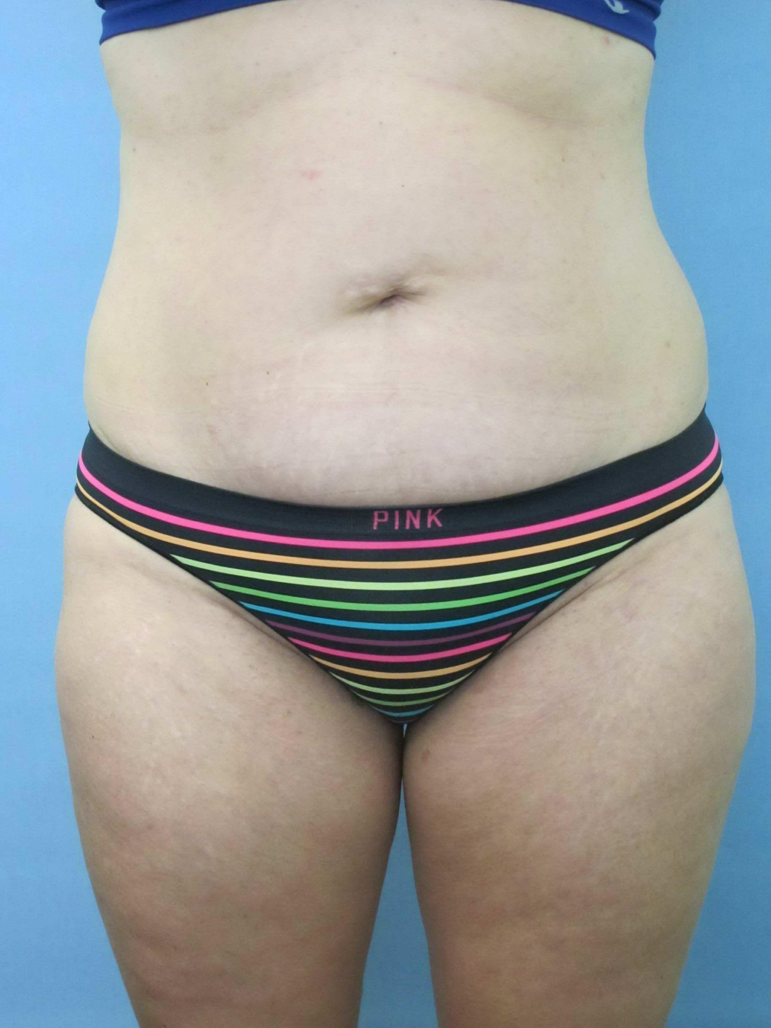 Liposuction Patient Photo - Case 154 - before view-0