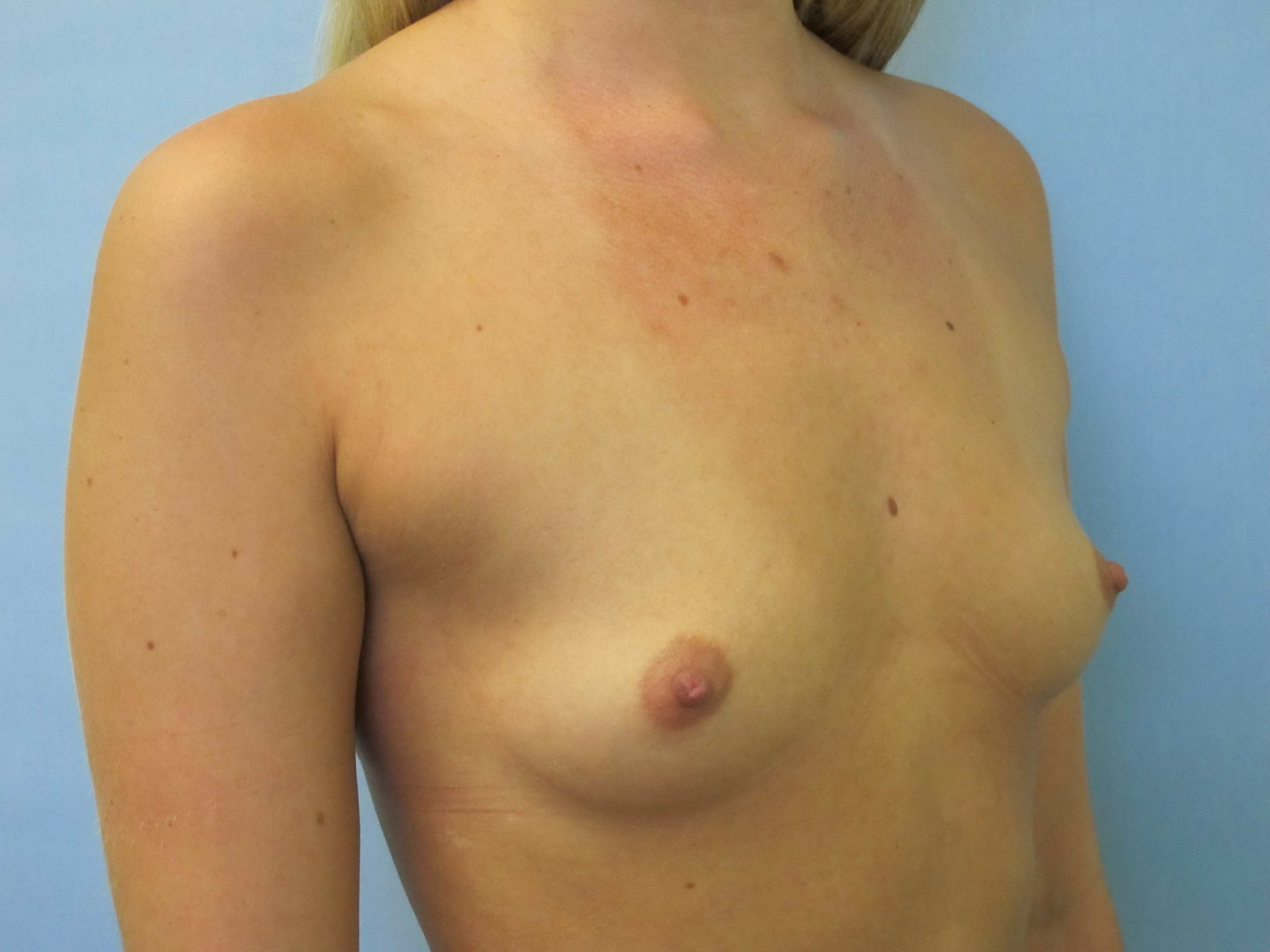 Breast Augmentation Patient Photo - Case 41 - before view-1