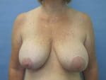 Breast Surgery Revision - Case 140 - Before