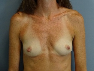 Breast Augmentation Patient Photo - Case 165 - before view-