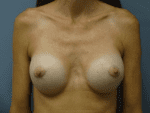 Breast Augmentation - Case 165 - After