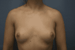 Breast Augmentation - Case 164 - Before