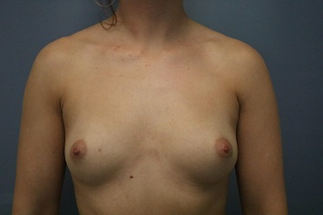 Breast Augmentation Patient Photo - Case 164 - before view-0