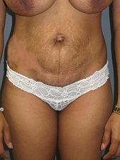 Tummy Tuck Patient Photo - Case 166 - before view-0