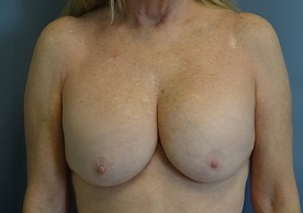 Breast Surgery Revision Patient Photo - Case 170 - before view-0