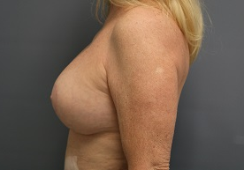 Breast Surgery Revision Patient Photo - Case 170 - after view-1