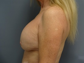 Breast Surgery Revision Patient Photo - Case 170 - before view-1