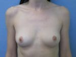 Breast Augmentation - Case 143 - Before