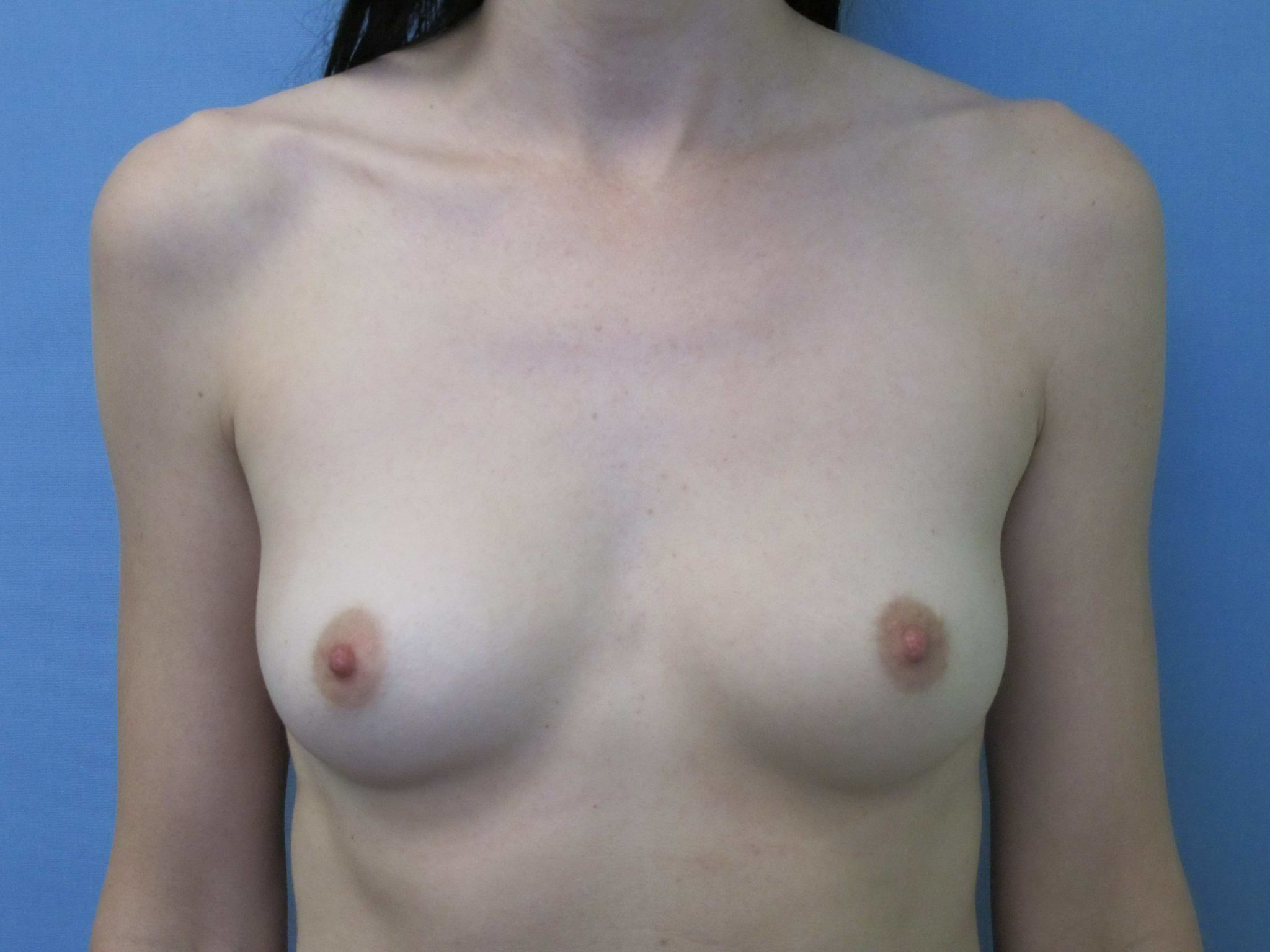 Breast Augmentation Patient Photo - Case 143 - before view-