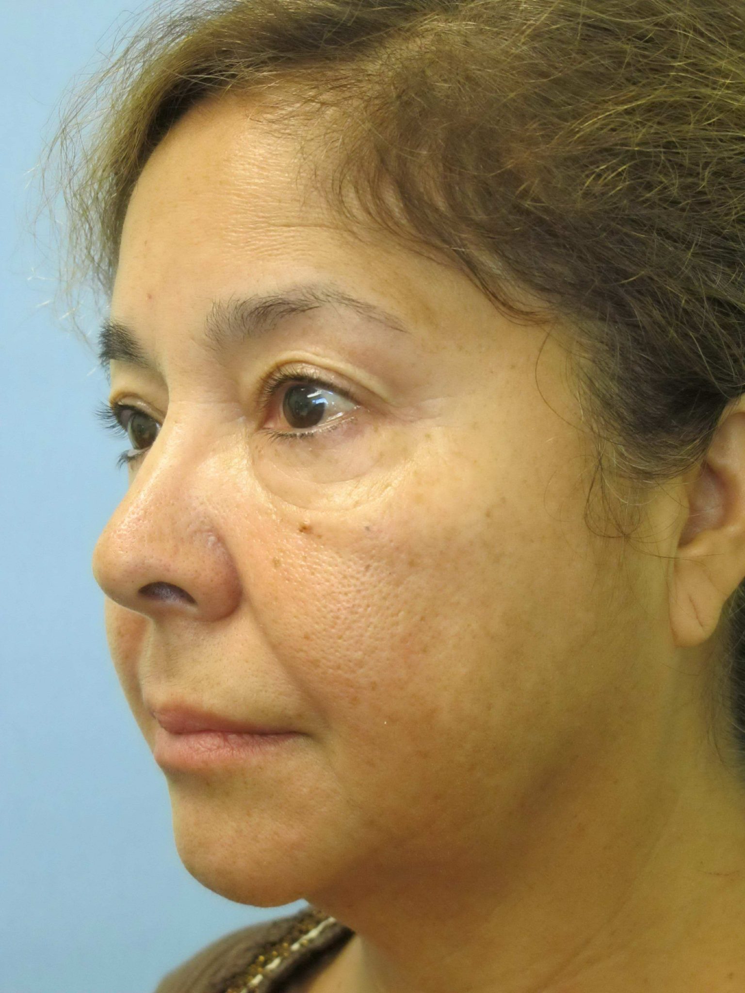 Liposuction Patient Photo - Case 137 - before view-0