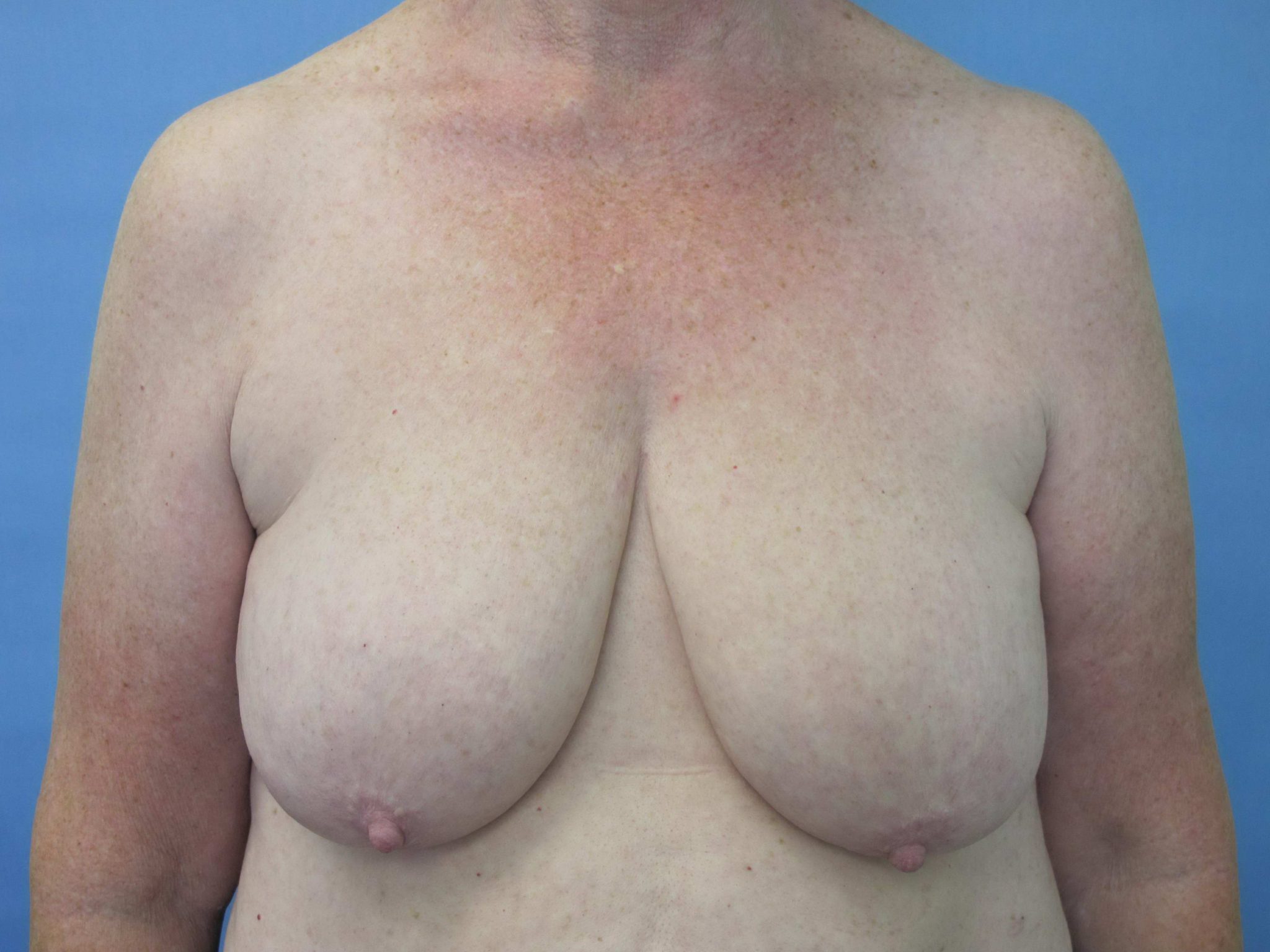 Breast Lift Patient Photo - Case 72 - before view-