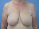 Breast Reduction - Case 72 - Before