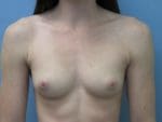 Breast Augmentation - Case 129 - Before