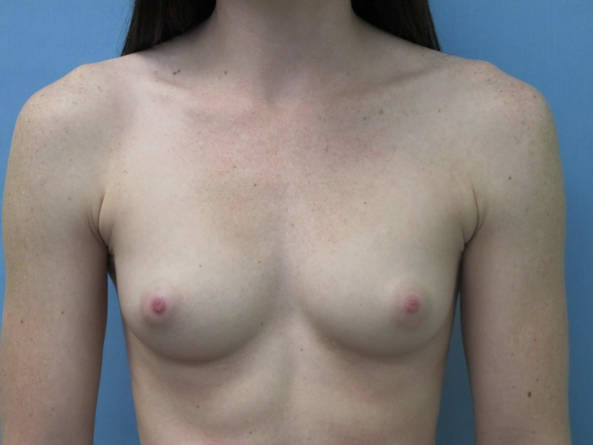 Breast Augmentation Patient Photo - Case 129 - before view-0