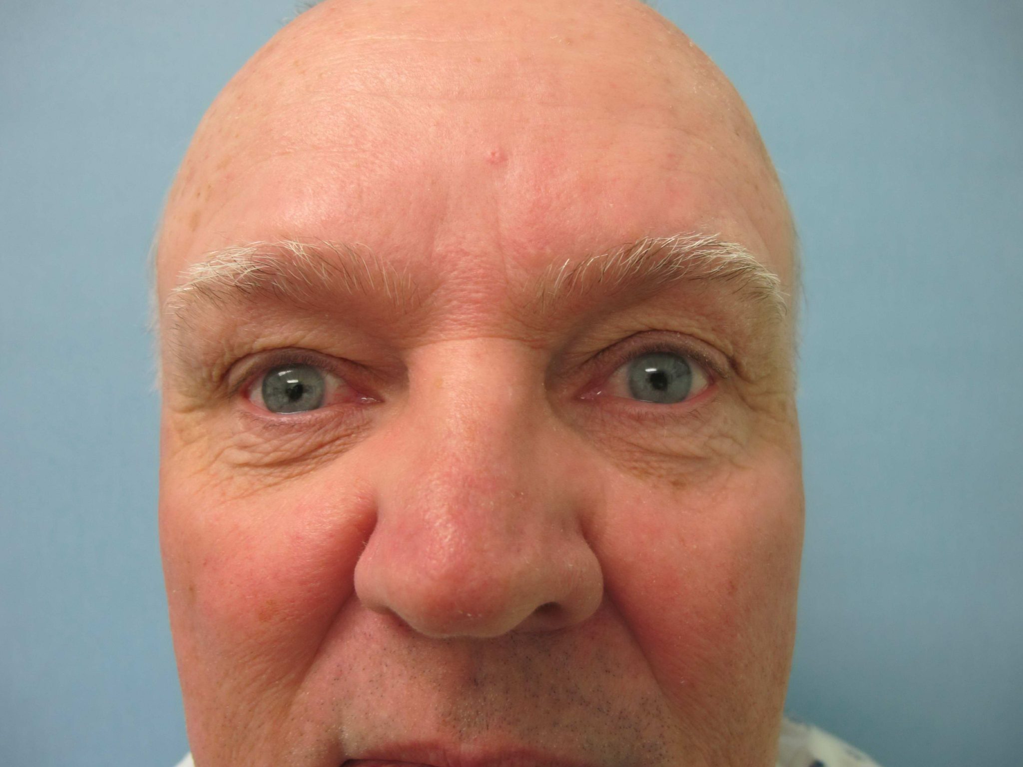 Eyelid Surgery Patient Photo - Case 126 - before view-