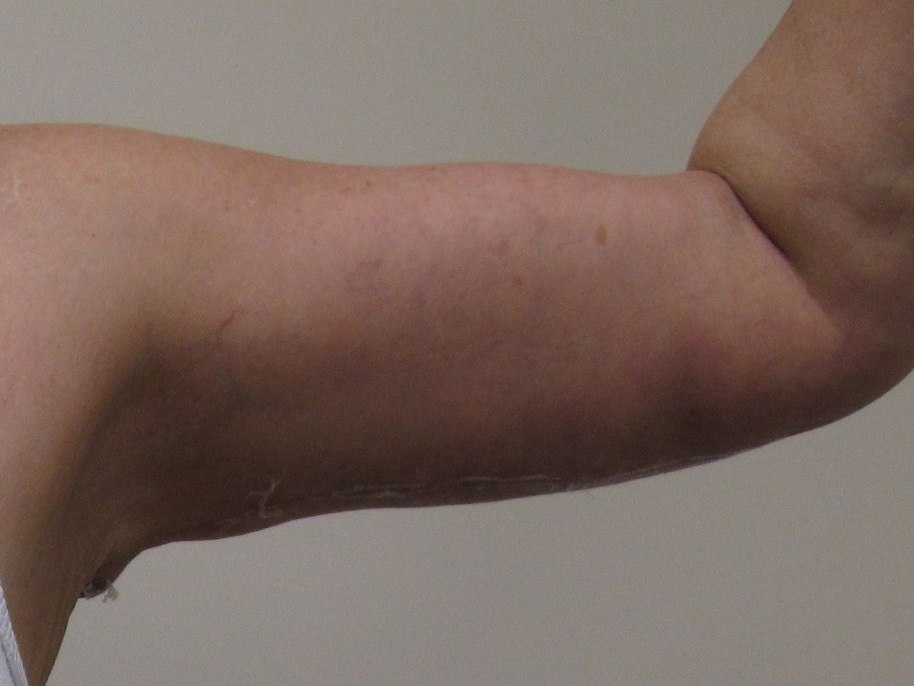 Arm Lift Patient Photo - Case 114 - after view-1