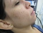 Laser Treatments - Case 130 - Before