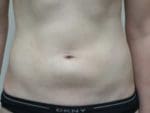 Liposuction - Case 146 - Before
