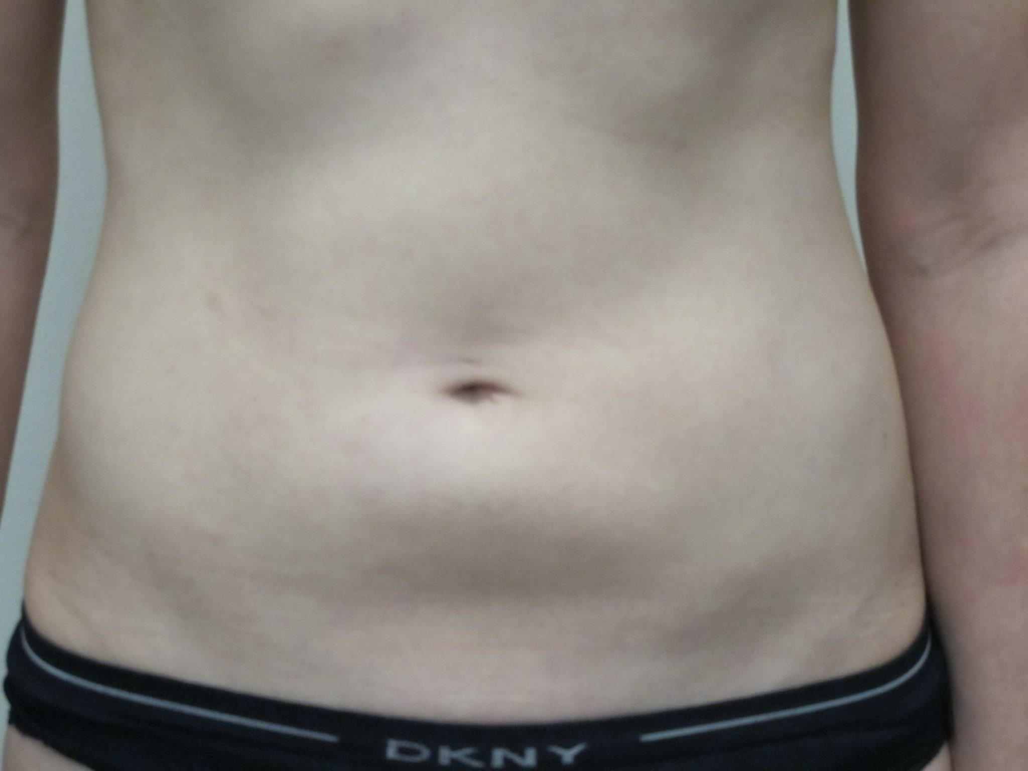 Liposuction Patient Photo - Case 146 - before view-