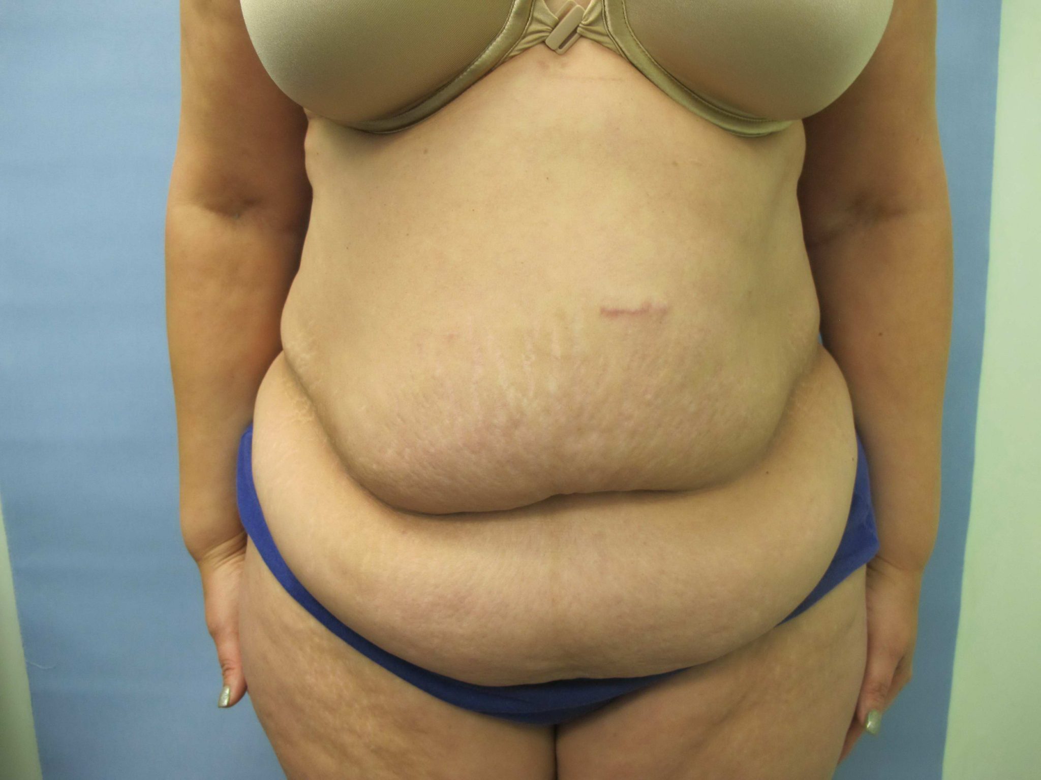 Avelar Tummy Tuck Patient Photo - Case 127 - before view-