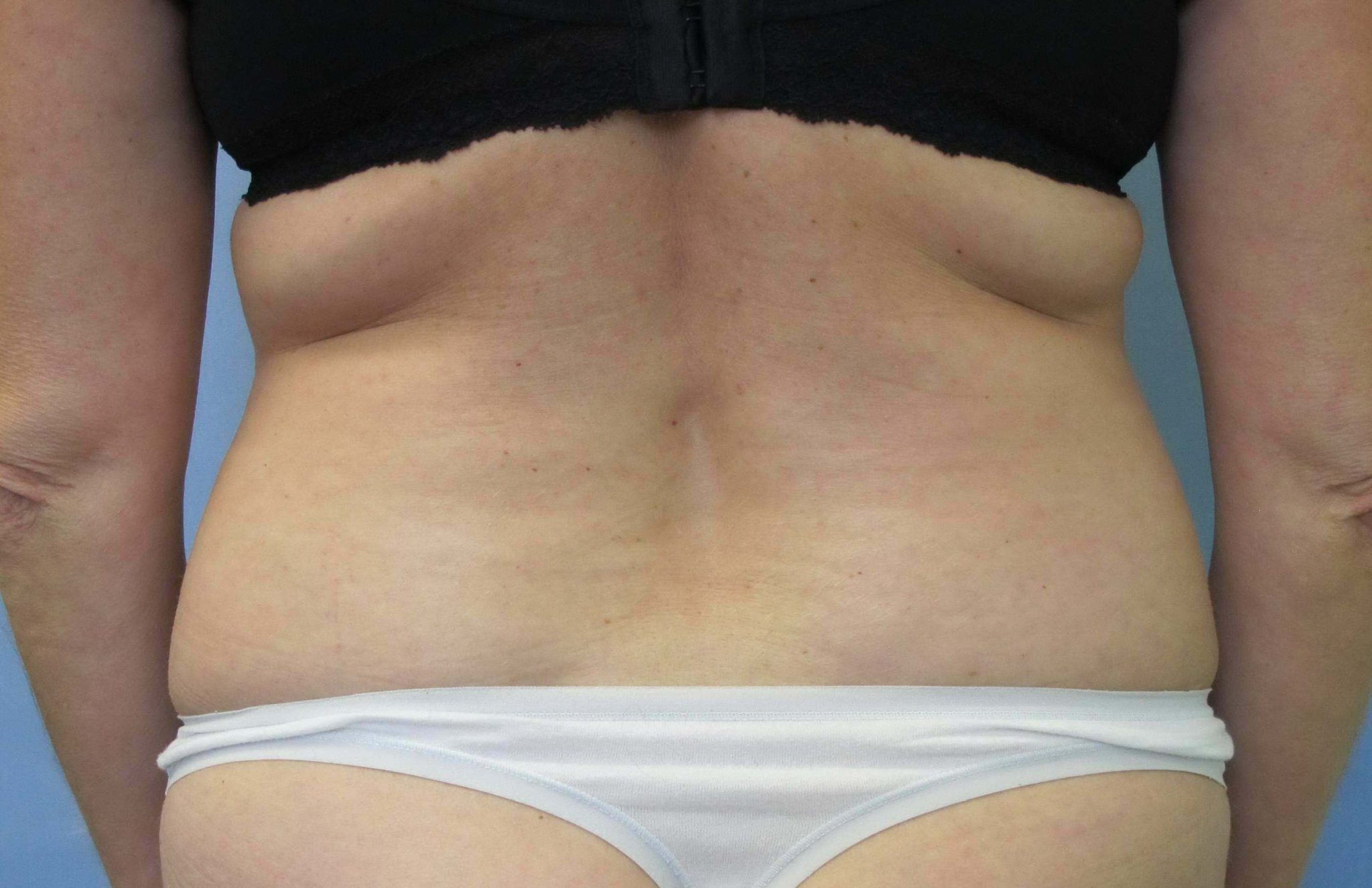 Liposuction Patient Photo - Case 83 - before view-