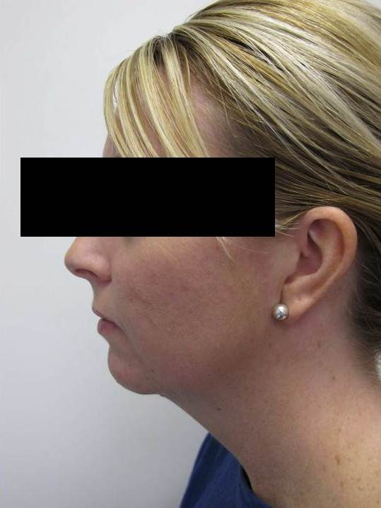 Chin/Cheek Implant Patient Photo - Case 57 - before view-0