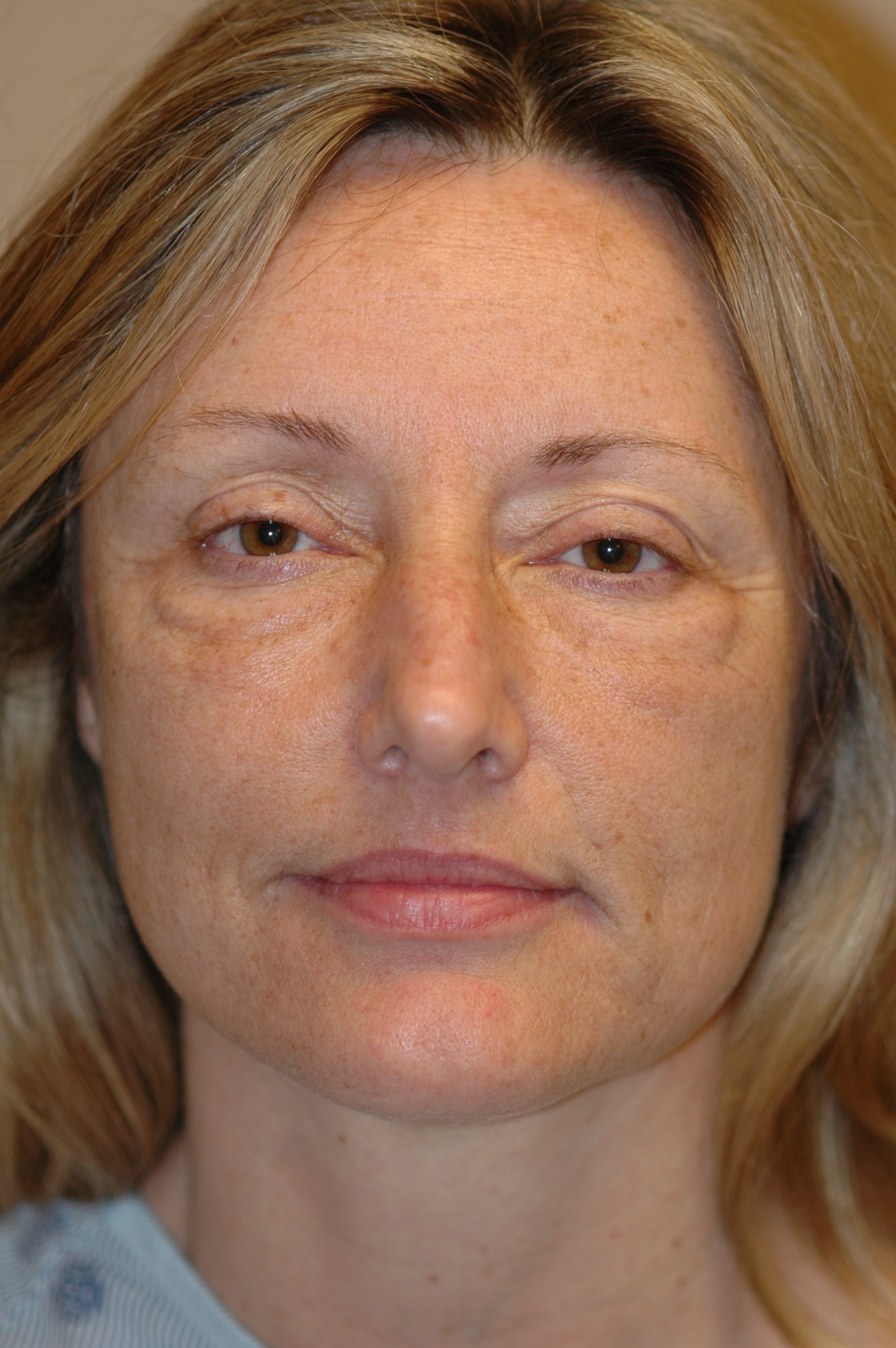Eyelid Surgery Patient Photo - Case 104 - before view-0