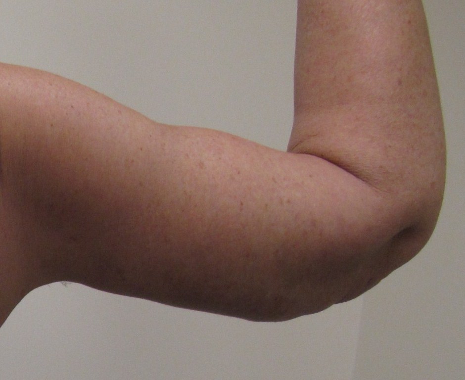 Arm Lift Patient Photo - Case 114 - after view-0