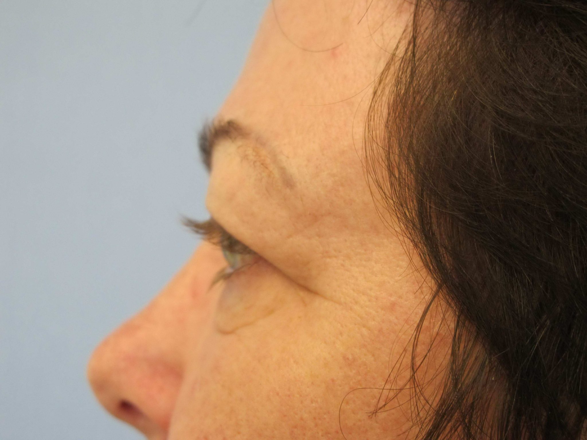 Eyelid Surgery Patient Photo - Case 121 - before view-1