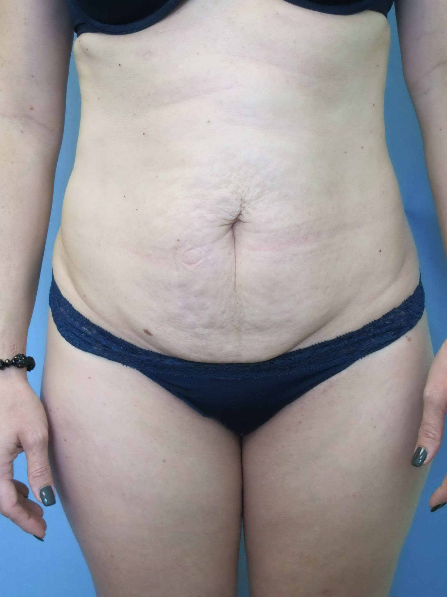 Liposuction Patient Photo - Case 115 - before view-