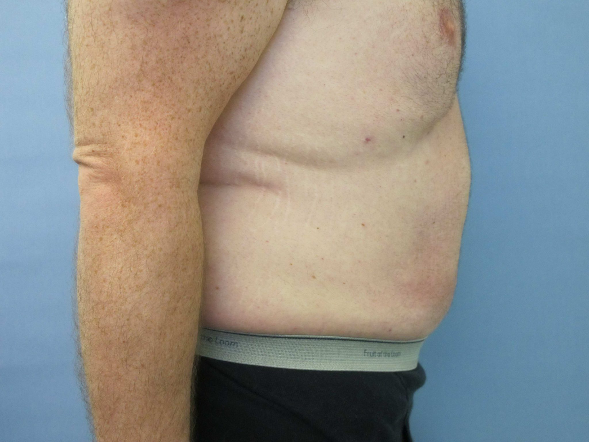 Tummy Tuck Patient Photo - Case 76 - after view-1
