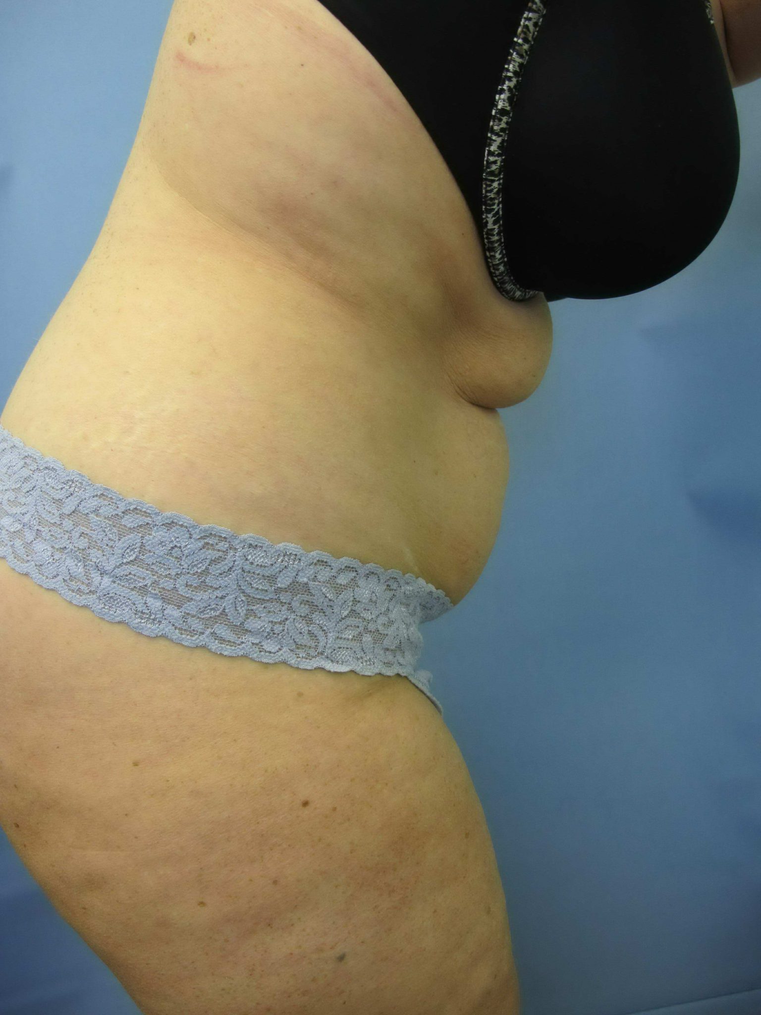 Liposuction Patient Photo - Case 84 - before view-1