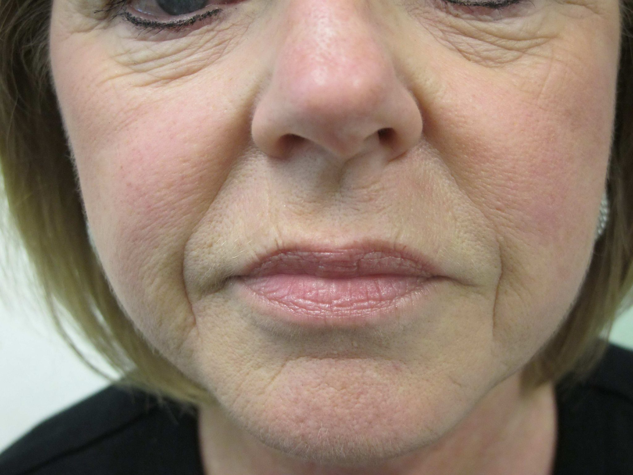 Injectable Fillers Patient Photo - Case 133 - before view-