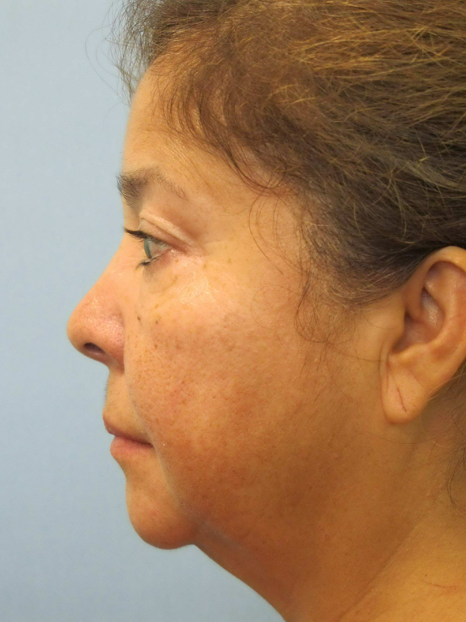 Liposuction Patient Photo - Case 137 - before view-1