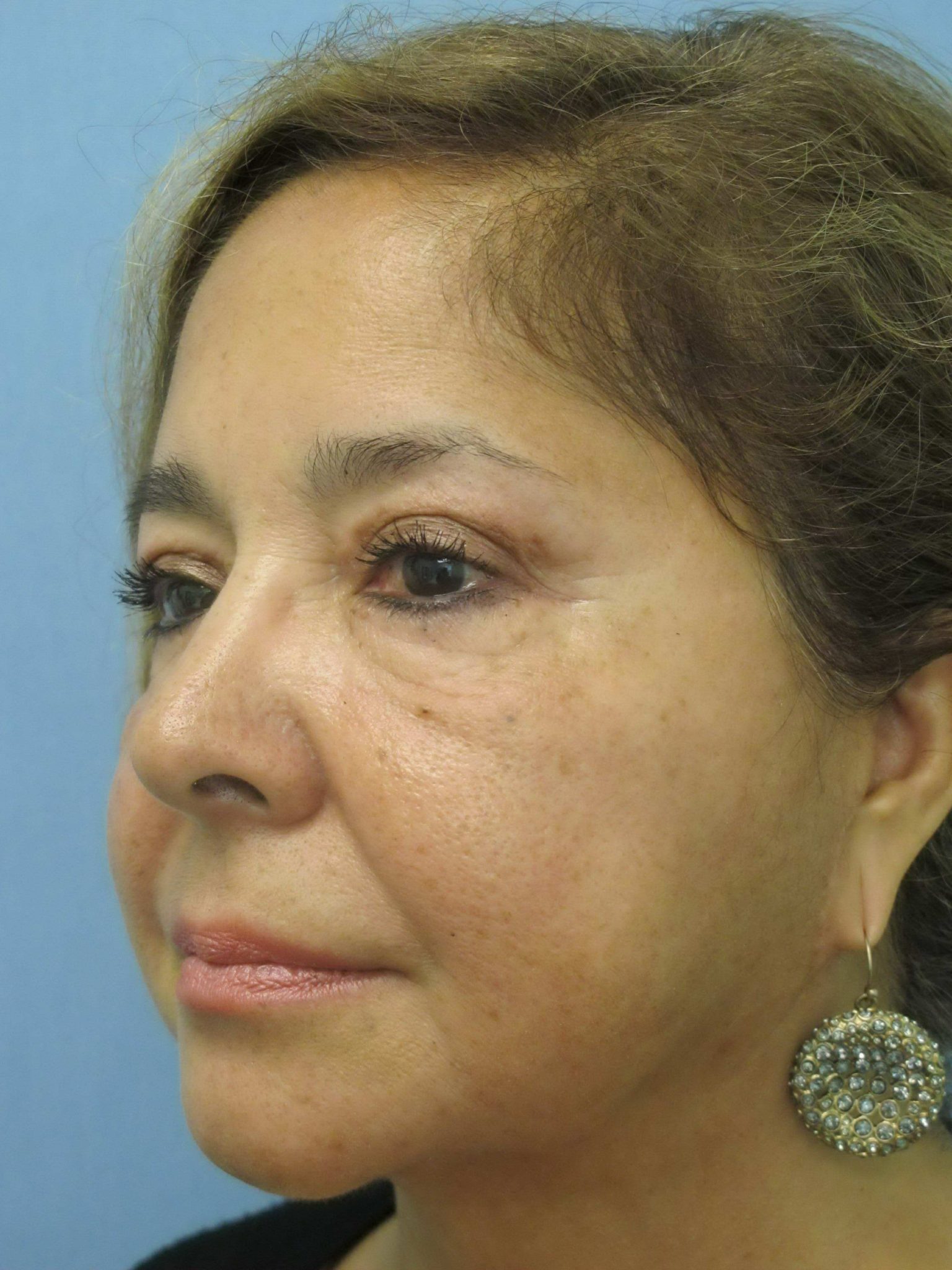 Liposuction Patient Photo - Case 137 - after view