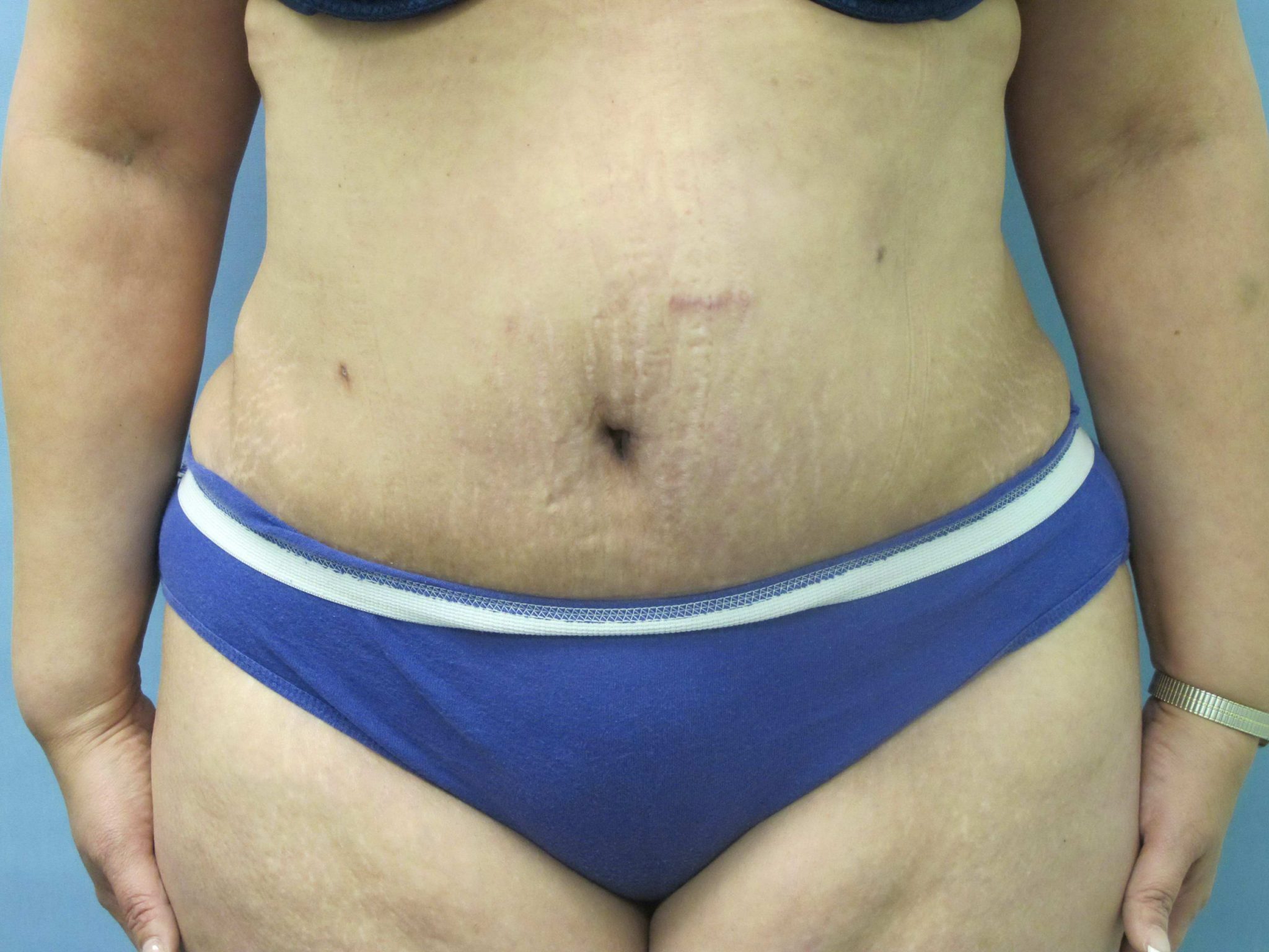 Liposuction Patient Photo - Case 127 - after view-0