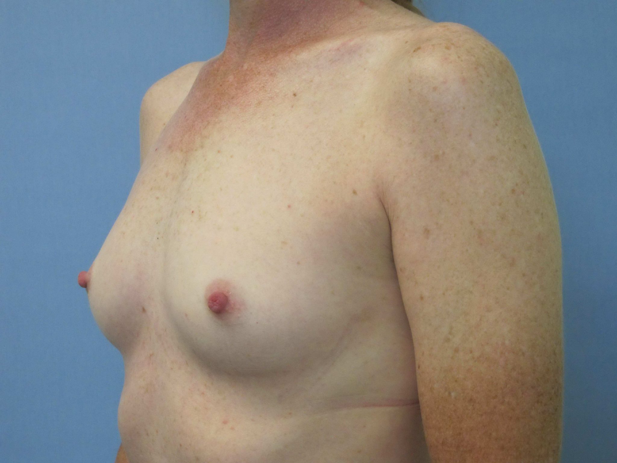 Breast Augmentation Patient Photo - Case 43 - before view-