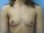 Breast Augmentation - Case 134 - Before