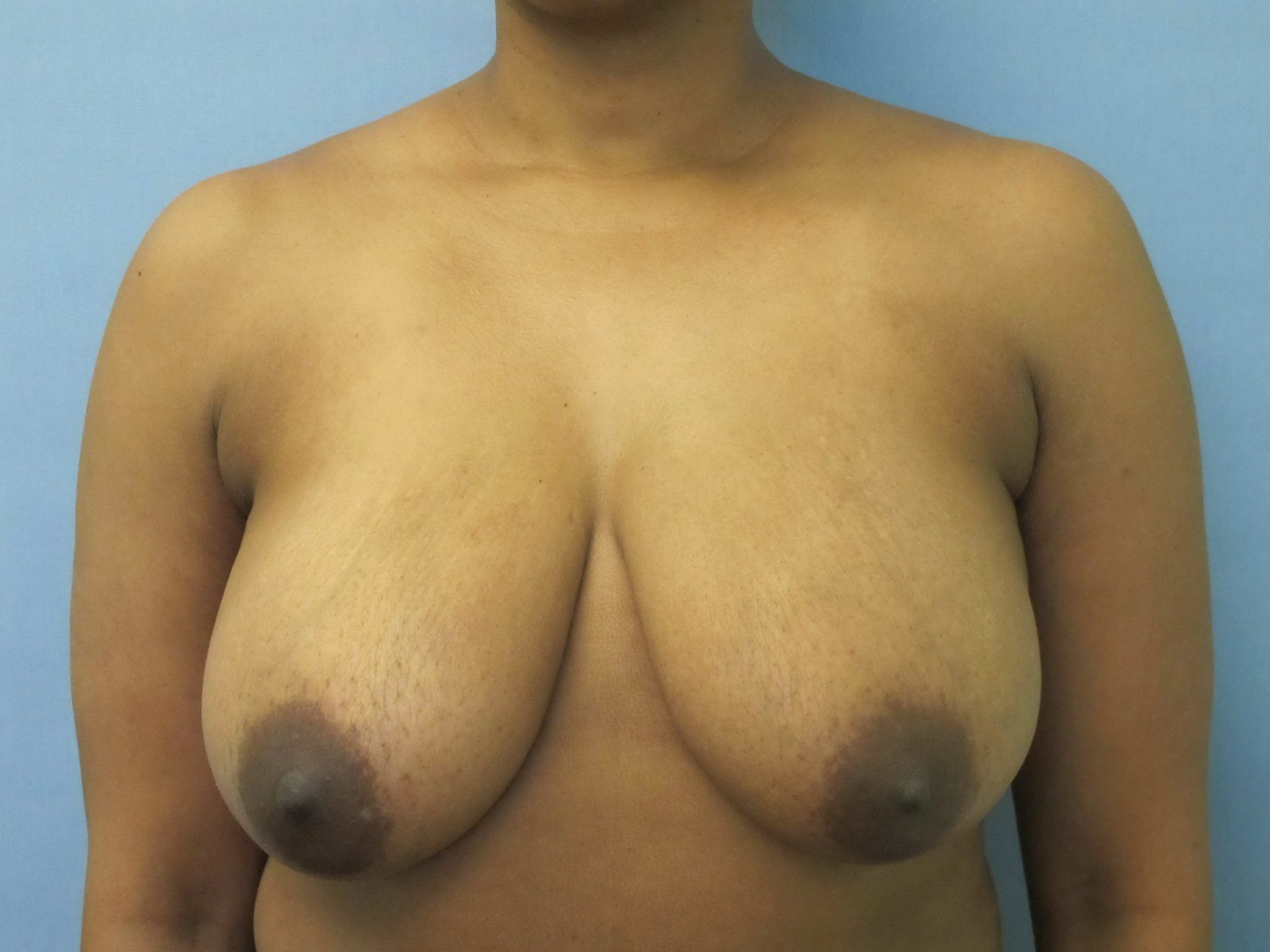 Breast Reduction Patient Photo - Case 141 - before view-0