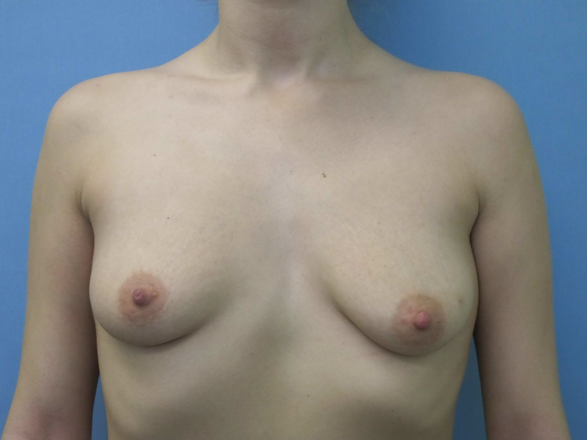 Breast Augmentation Patient Photo - Case 128 - before view-0