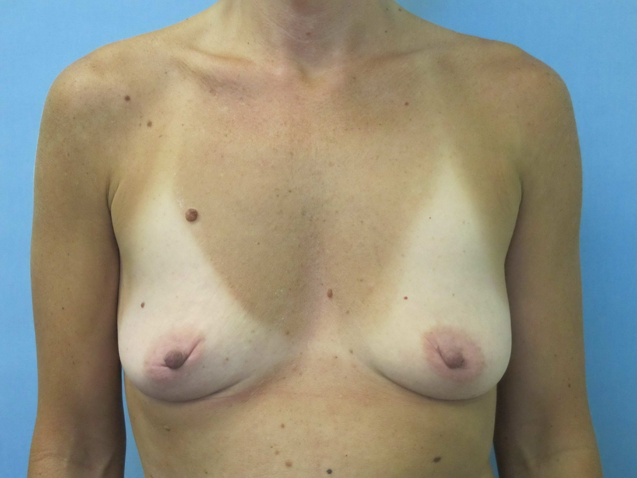 Breast Augmentation Patient Photo - Case 142 - before view-