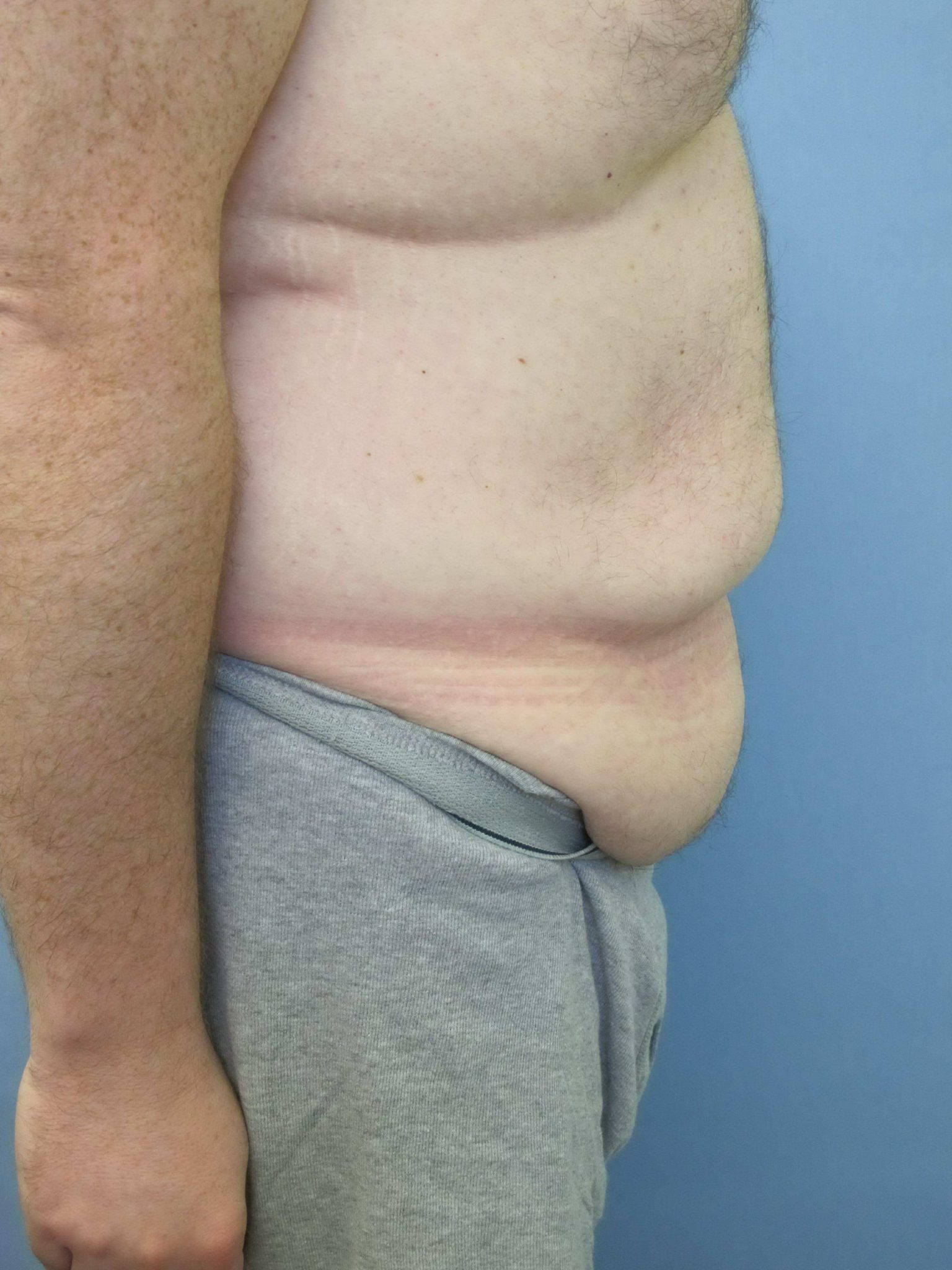 Liposuction Patient Photo - Case 76 - before view-1