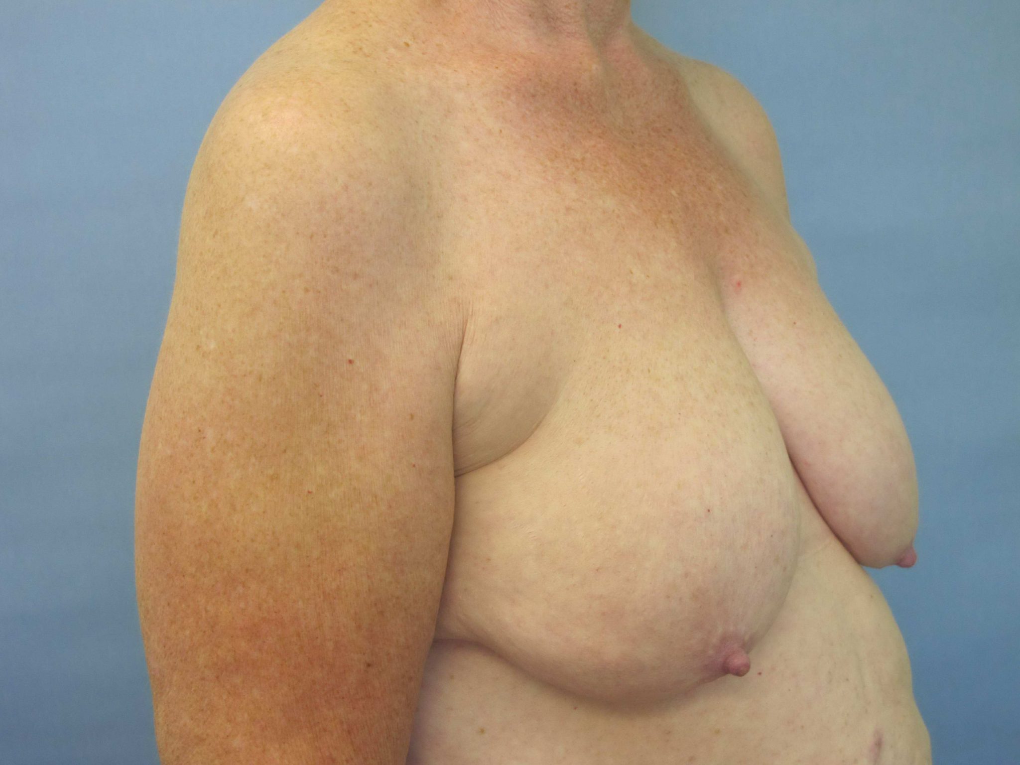 Breast Lift Patient Photo - Case 72 - before view-1
