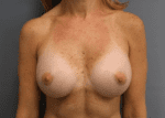Breast Augmentation - Case 167 - After