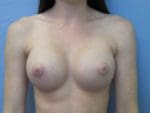 Breast Augmentation - Case 129 - After