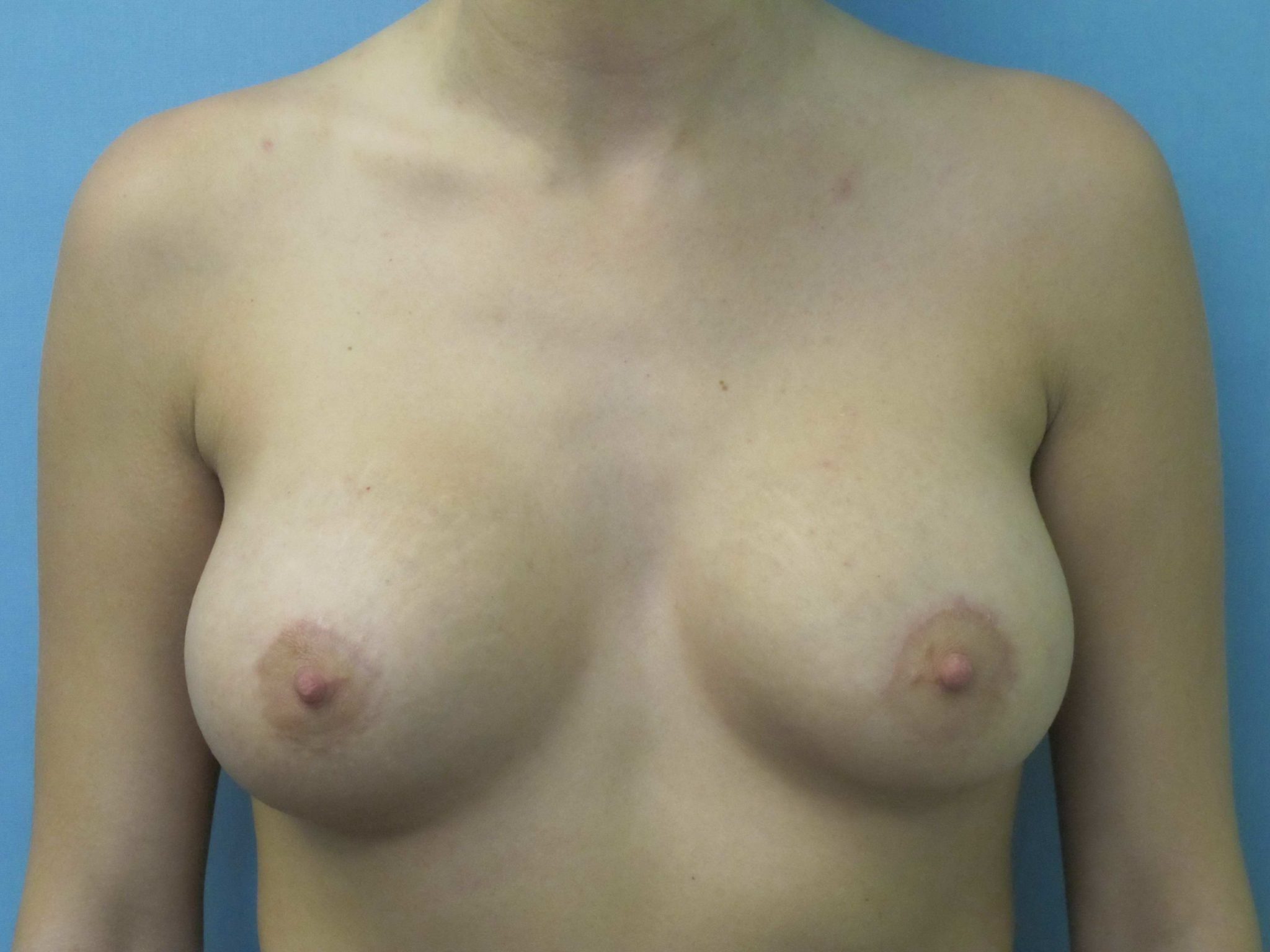 Breast Augmentation Patient Photo - Case 128 - after view-0
